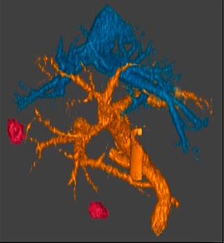 Developing a Vaccine to Prevent Pancreatic Cancer in High-Risk Individuals