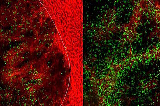 Researchers discover why colon cancer can evade immunotherapy